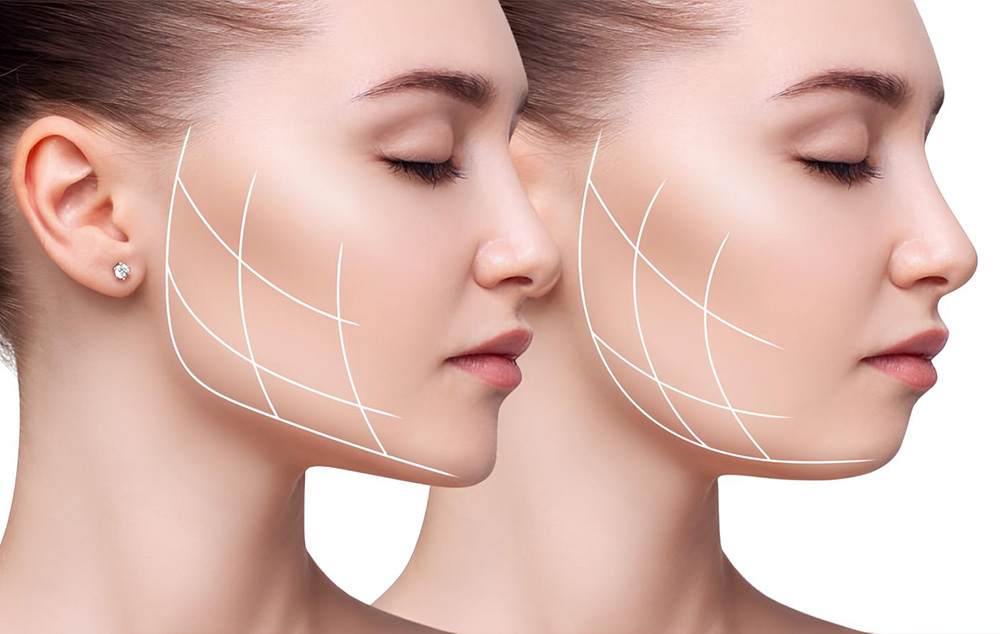ÖZEL DENT ULUCAN - AĞIZ VE DİŞ SAĞLIĞI POLİKLİNİĞİ Masseter Botoksu Nedir?