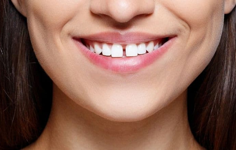 ÖZEL DENT ULUCAN - AĞIZ VE DİŞ SAĞLIĞI POLİKLİNİĞİ Diestema (Ayrık Diş) Nedir? Nasıl Tedavi Edilir?